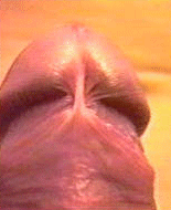 Penis Vorhaut zurückgezogen, Frenulum/Bändchen deutlich sichtbar Penis Vorhaut zurückgezogen, Frenulum/Bändchen deutlich sichtbar